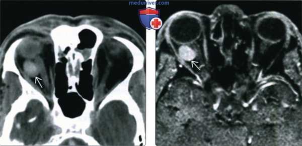 КТ, МРТ при кавернозной венозной мальформации глазницы (гемангиоме)