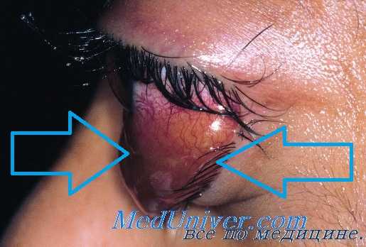 кавернозная гемангиома глаза