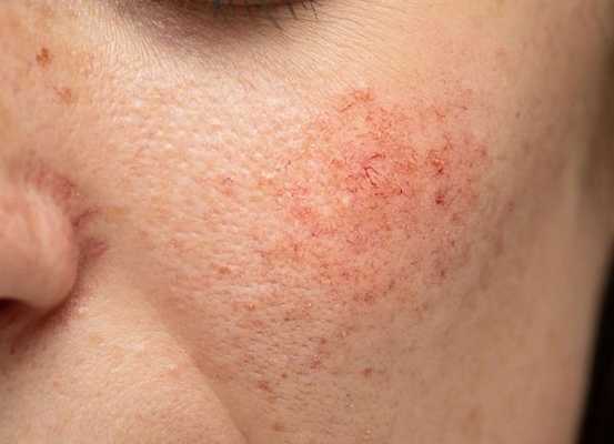 Изменение капилляров при куперозе