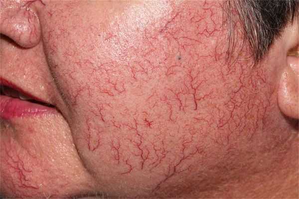 Сосудистые звездочки (телеангиоэктазии)