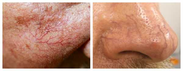 Поверхностные (слева) и глубокие сосудистые звёздочки (справа)