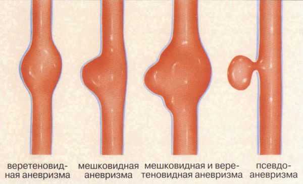 Аневризмы
