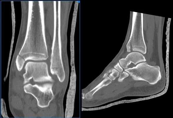 Компьютерная томография голеностопного сустава