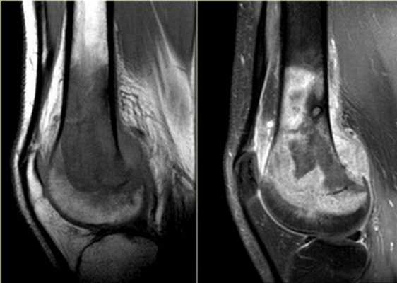 Остеосаркома коленного сустава на МРТ
