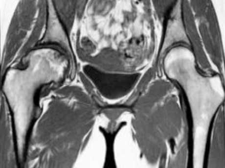 МРТ костей таза