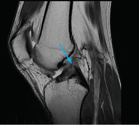 разрыв крестообразной связки