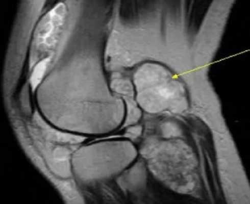 МРТ коленного сустава