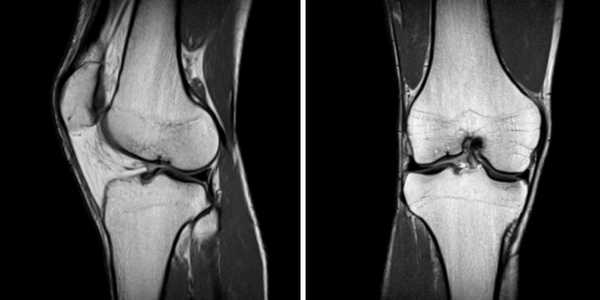МРТ колена: гонартроз