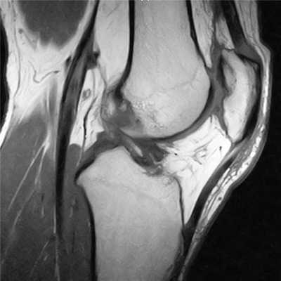 МРТ коленного сустава фото