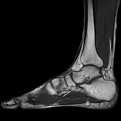 Какие заболевания покажет МРТ голеностопного сустава