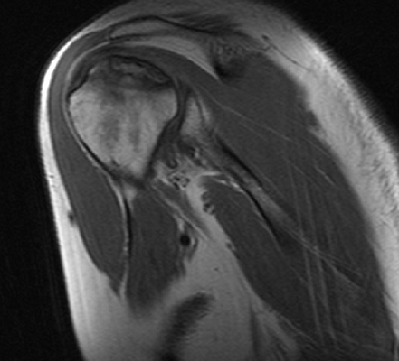 МРТ плечевого сустава