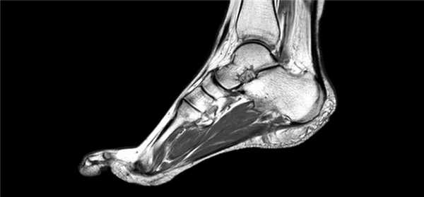 МРТ голеностопного сустава