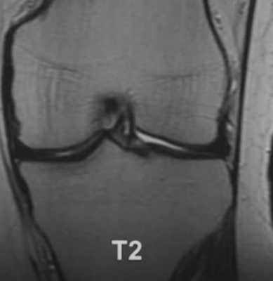 МР-снимок коленного сустава в режиме Т2