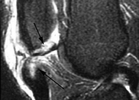 МРТ: перелом надколенника