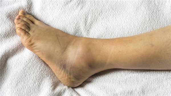 отек голеностопного сустава