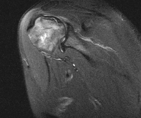 МРТ плечевого сустава
