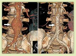 Эндопротезирование аорты
