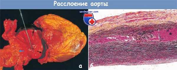Расслоение аорты