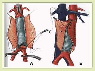 Открытое протезирование аорты