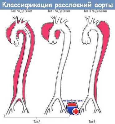 Классификация расслоений аорты