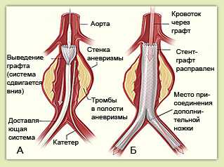 Эндопротезирование аорты