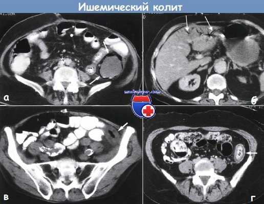 Ишемический колит