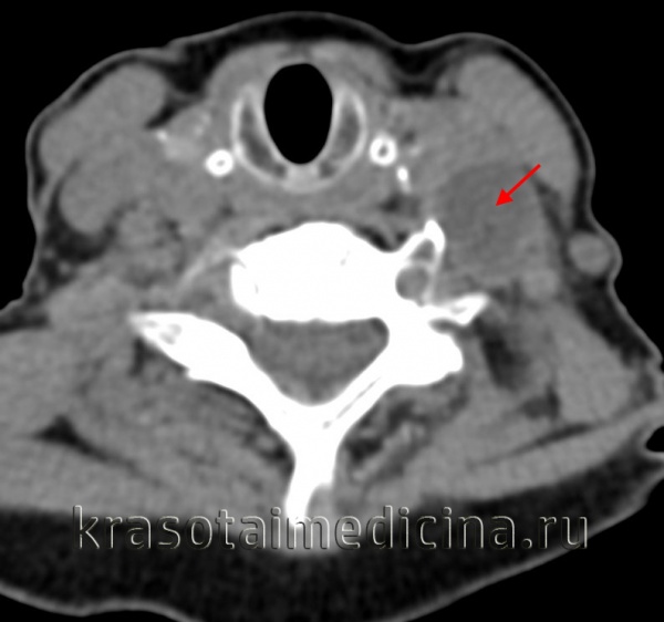 Лигатурный свищ