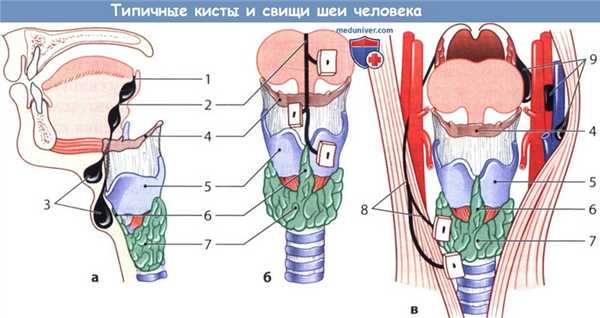 Кисты и свищи шеи человека