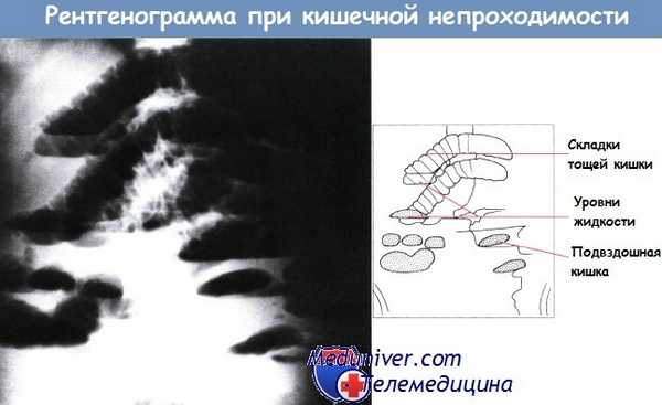 Обзорная рентгенограмма при непроходимости тонкой кишки