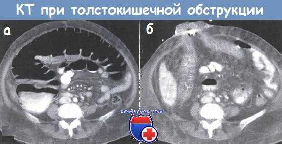 КТ при толстокишечной обструкции