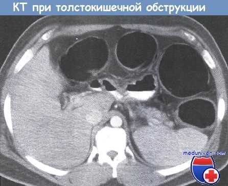 КТ при толстокишечной обструкции