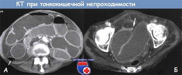 КТ при непроходимости тонкой кишки