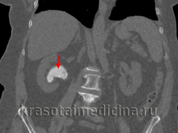 Камни в почках