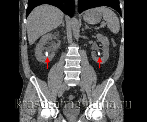Камни в почках