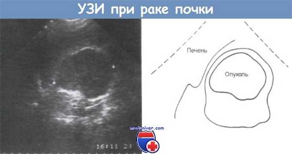УЗИ при раке почки