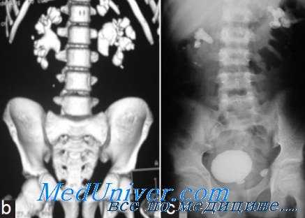 КТ и рентгенография при мочекаменной болезни (МКБ)