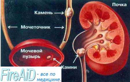 Камень в почках