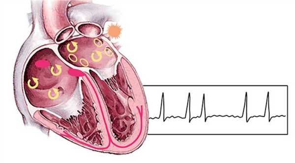 Мерцательная аритмия
