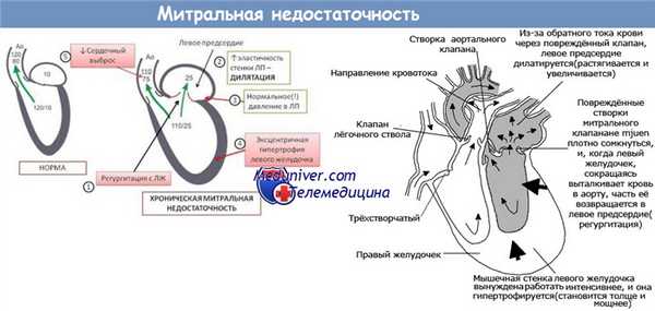 Митральная недостаточность