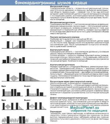 Фонокардиограмма шумов сердца