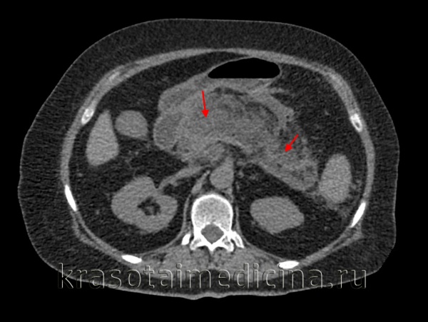 Панкреатит