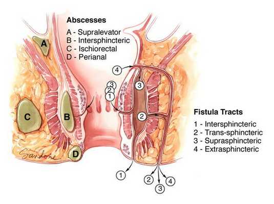Абсцесс и свищевой ход
