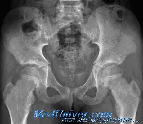 переломы костей таза