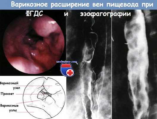 Варикозное расширение пищевода