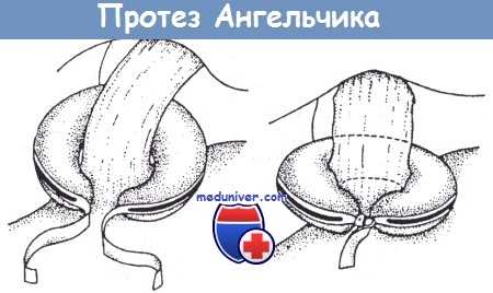 Протез Ангельчика