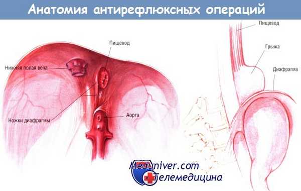 Анатомия антирефлюксных операций при ГЭРБ