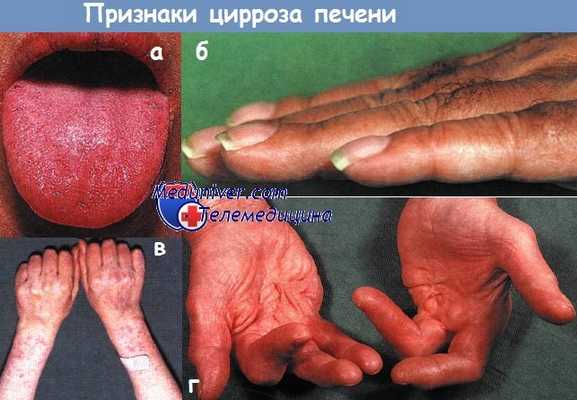 Признаки цирроза печени
