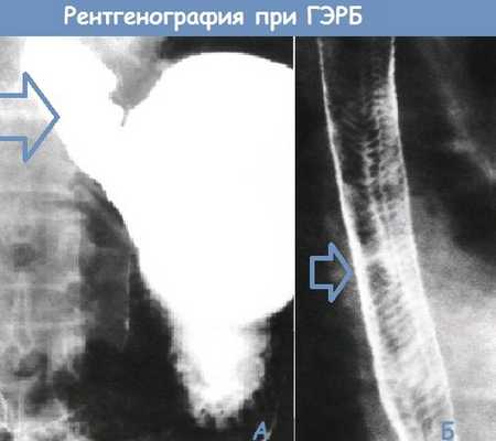 Рентгенография при ГЭРБ