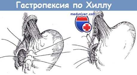 Гастропексия по Хиллу