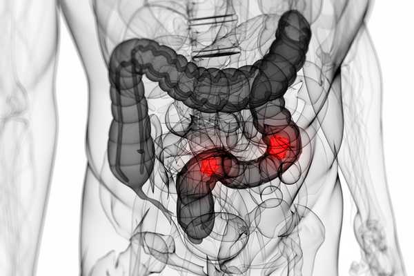 Рак толстой кишки (Колоректальный рак)